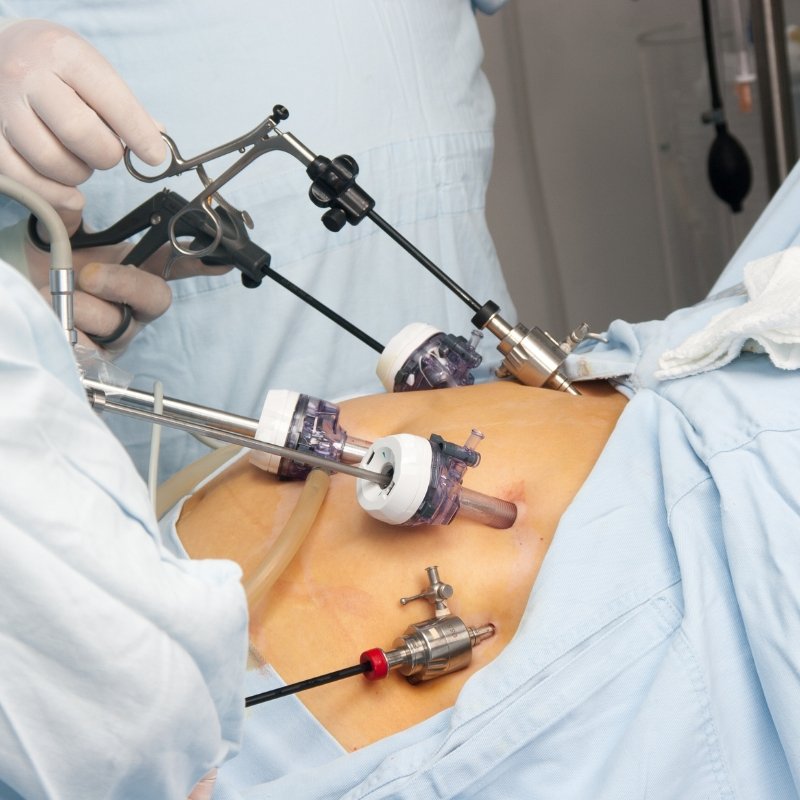 Cirugía Bariátrica Revisional