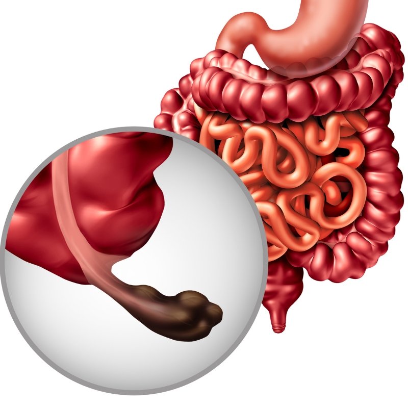 Apendicitis Aguda