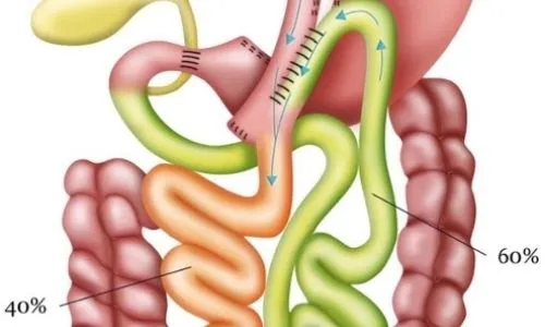 Bypass de una sola anastomosis (OAGB)