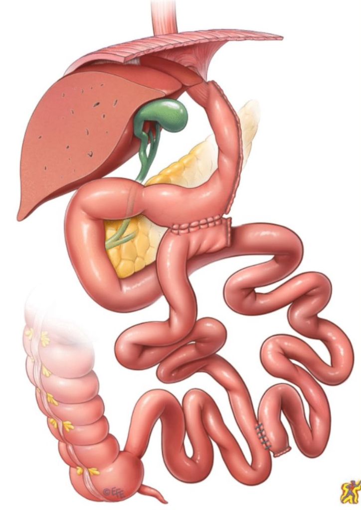 Gastrectomía en Manga con Bipartición de Tránsito Intestinal