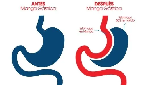 Bypass Gástrico
